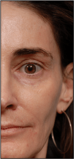 Hollow temples before dermal fillers