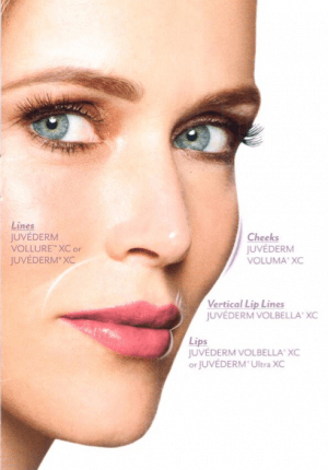 Juvederm illustration