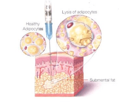 Kybella illustration