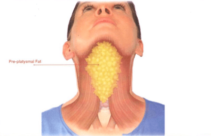 Under-Chin fat