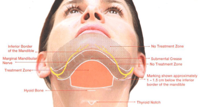 Kybella illustration