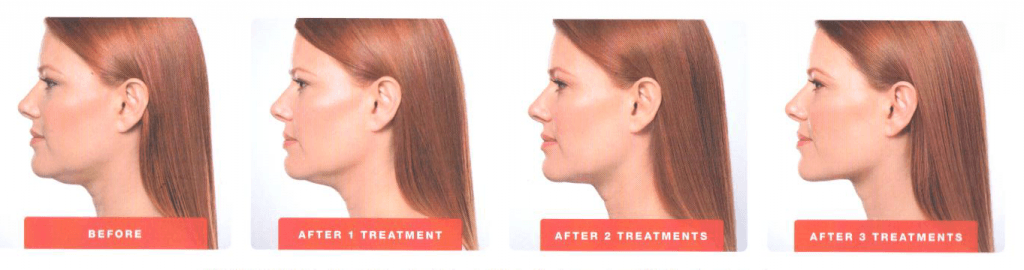 Before and After Kybella Treatments