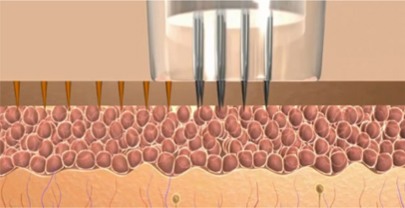 MicroPen illustration