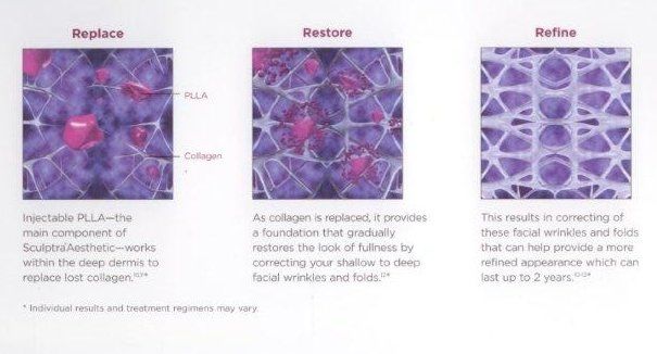 Sculptra reshapes restores and refines 