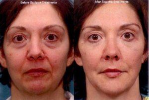 Before and After Sculptra