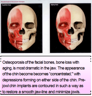 Chin Implants Information