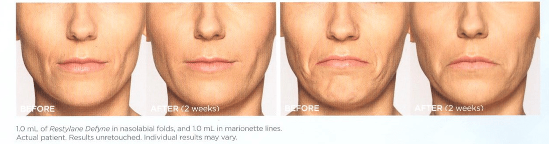 Before and After Restlyane Treatments