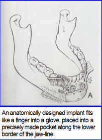 Jaw Implant