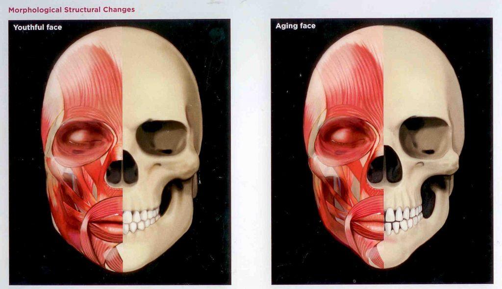 Facial skeleton illustrating jawline volume loss